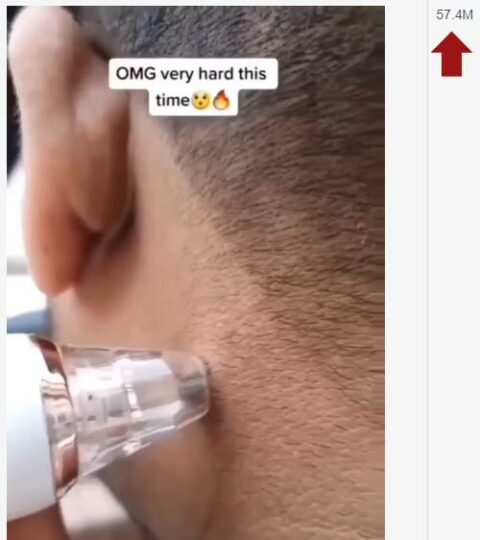 Facebook Video of Man Yanking a Mole on his Neck